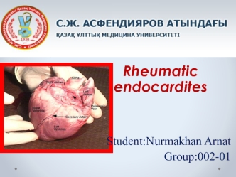 Rheumatic endocardites