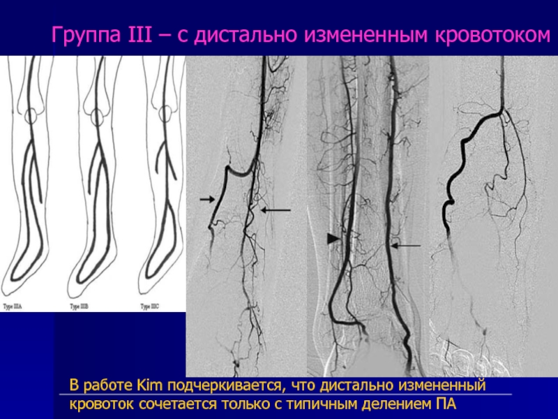 Дистальные артерии. Варианты развития артерий голени. Дистальная флебография. Измененный кровоток. Дистальные участки вен.
