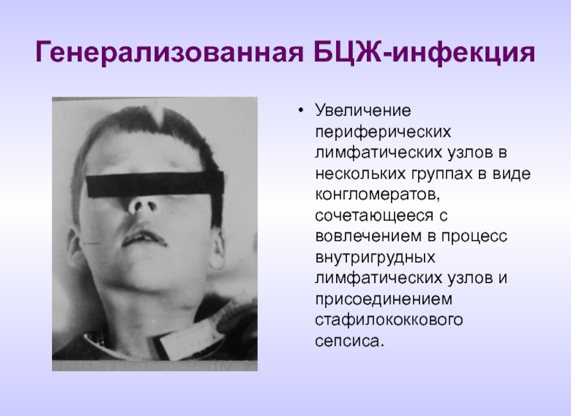 Конгломерат узлов. Увеличение периферических лимфатических узлов. Конгломерат шейных лимфатических узлов. Генерализованная БЦЖ-инфекция. Что такое конгломераты лимфоузлы.