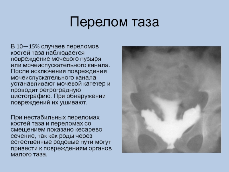 Перелом костей таза карта вызова