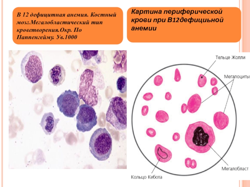 Анемия в12 дефицитная анемия картина крови