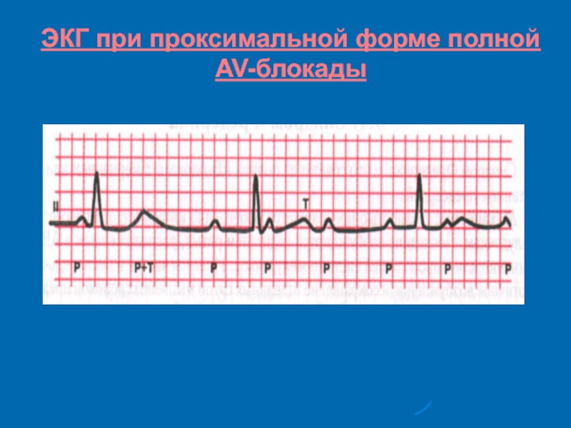 Ав блокада презентация