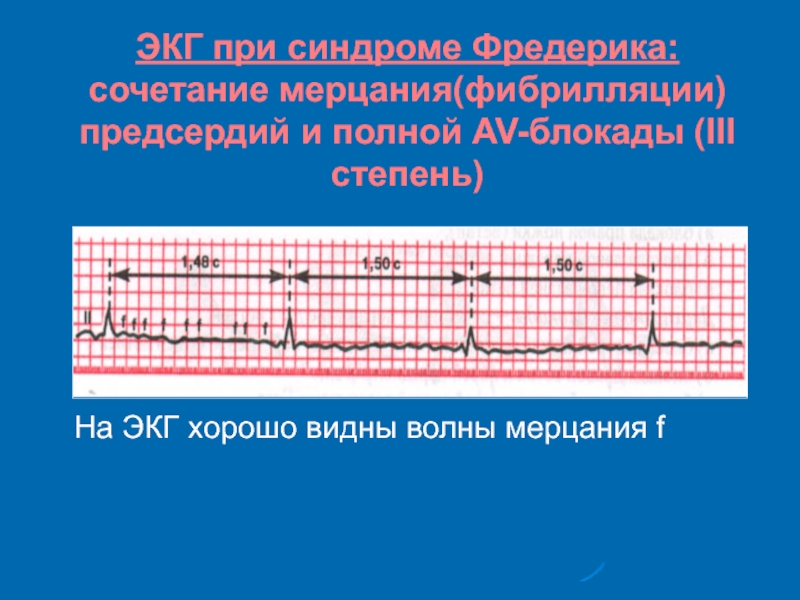 Синдром фредерика на экг фото