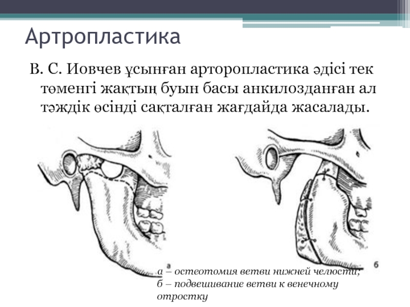 Буын синдромы презентация