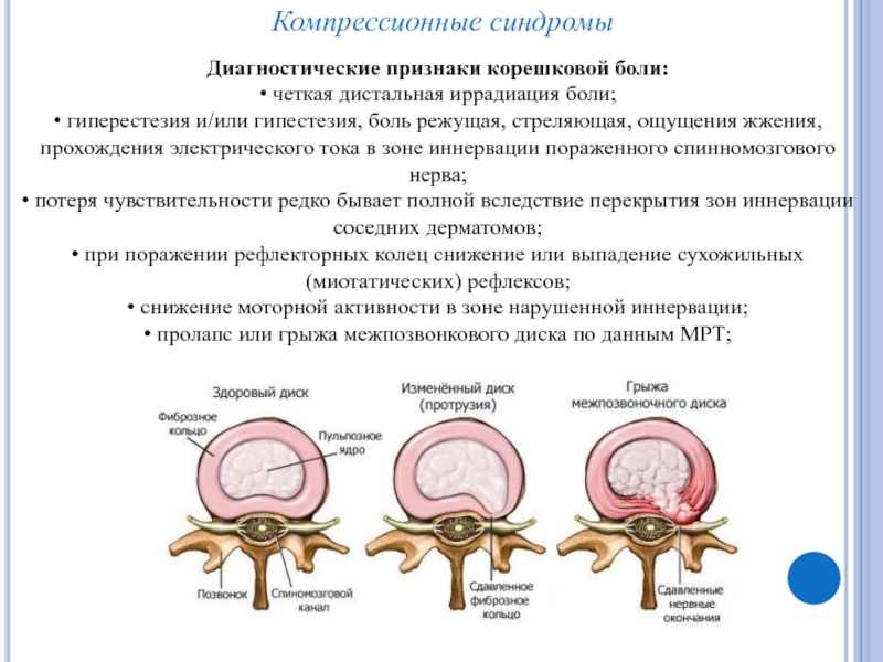 Остеохондроз корешковый синдром лечение