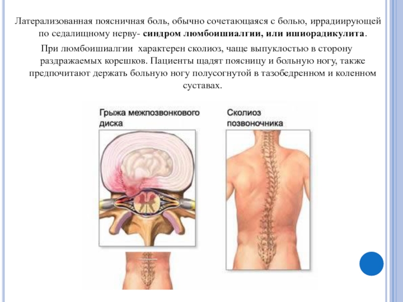 Люмбоишиалгия поясничного отдела позвоночника карта вызова