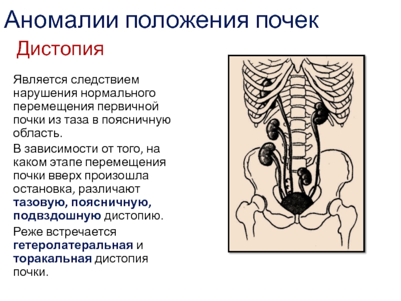 Дистопия левой почки