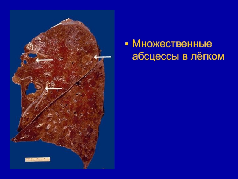 Абсцесс легкого презентация