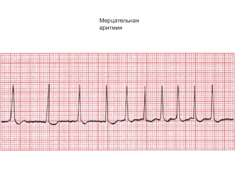 Экг мерцательная аритмия рисунок