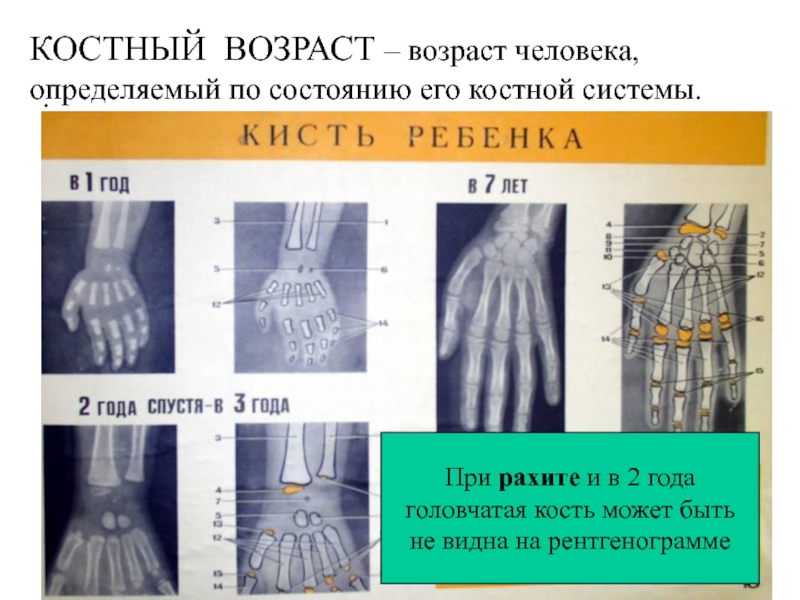 Костный возраст схема