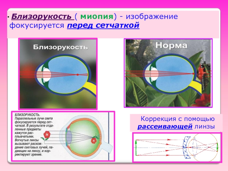 Если изображение фокусируется перед сетчаткой глаза возникает