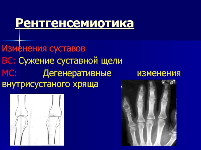 Дегенеративные заболевания суставов презентация