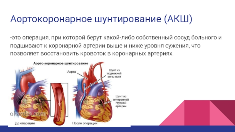 Что такое шунтирование сердца и сосудов. Аортокоронарное шунтирование операция. Аортокоронарное шунтирование (АКШ). Аорта коронарное шунтирование. Алрто коронарное шунтирование.