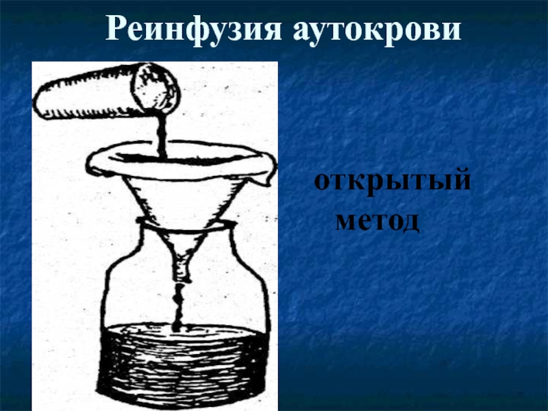 Открытый метод. Реинфузия аутокрови. Реинфузия схема. Реинфузия методика. Реинфузия аутокрови (понятие, методика)..