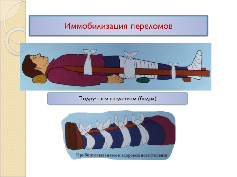 Подручные средства транспортной иммобилизации