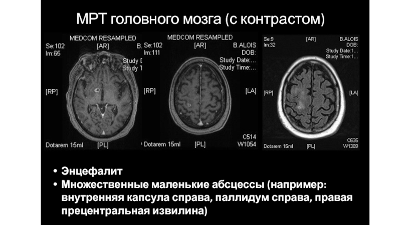 Мрт с контрастом головного