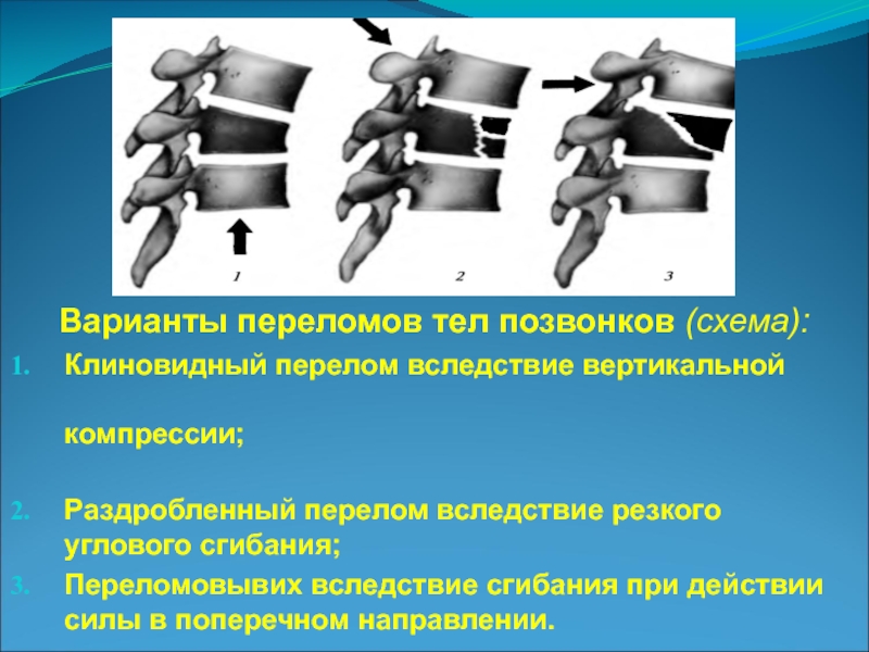 Компрессия тела позвонка