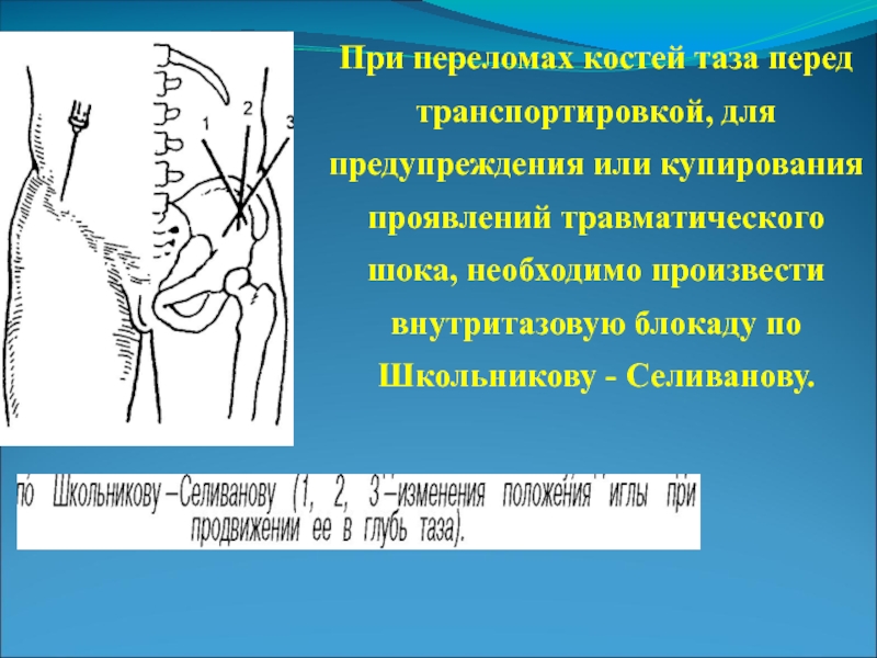 Блокады при переломах. Блокада по Школьникову-Селиванову техника. Новокаиновая блокада Школьникова Селиванова. Внутритазовая блокада по Школьникову-Селиванову. Блокада по Школьникову-Селиванову при переломах костей.