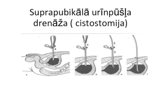 Suprapubikālā urīnpūšļa drenāža ( cistostomija)