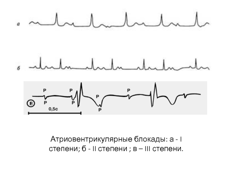 Блокада сердца степени. Атриовентрикулярная блокада. Блокада 1 степени. Bromage степень блокады. Пролапс митрального клапана 1 степени на ЭХОКГ.