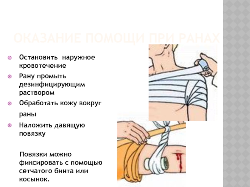 Давящая повязка какое кровотечение. Наложение повязок на раны. Наложение давящей повязки при кровотечении.