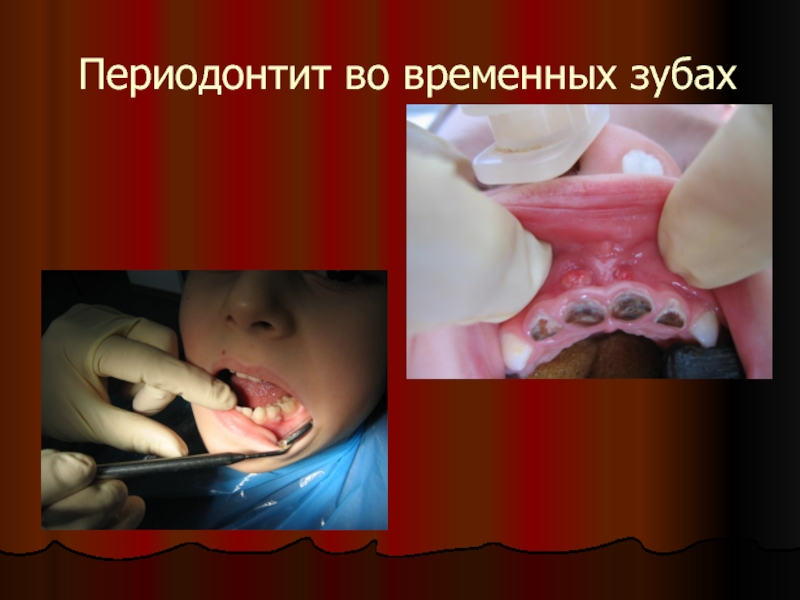 Периодонтит во временных зубах