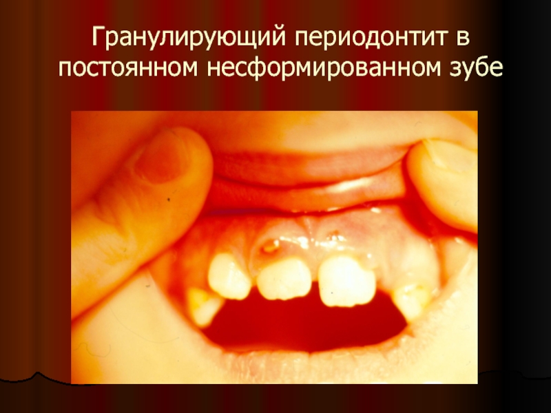 Гранулирующий периодонтит в постоянном несформированном зубе