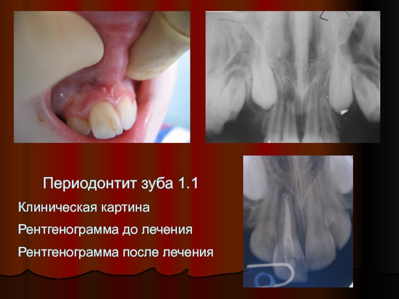 Периодонтит зуба 1.1Клиническая картинаРентгенограмма до лечения Рентгенограмма после лечения