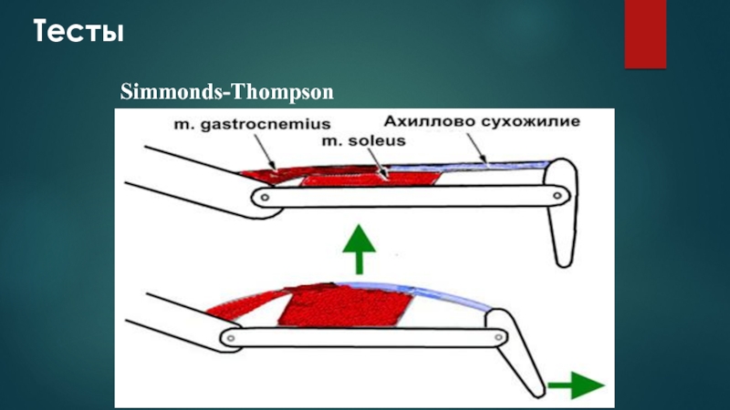 Теста томпсона. Тест Томпсона на ахиллово. Как сшивают ахиллово сухожилие.