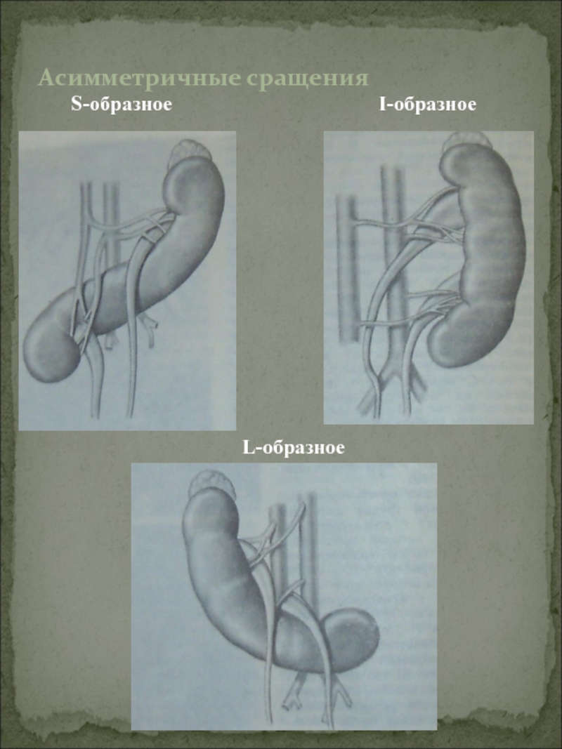 Нарушения развития почек. Аномалия почки l образно почка. S образное сращение почек. Аномалии сращения почек. Асимметричные - l- и s-образные почки.