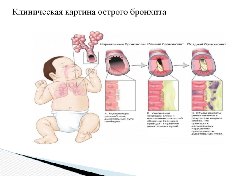 Клиническая картина острого бронхита