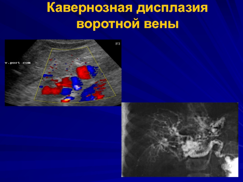 Тромбоз воротной. Кавернозная трансформация воротной вены на УЗИ. Кавернозная трансформация воротной вены кт. Кавернозная трансформация воротной вены у детей. Кавернозная трансформация воротной вены ультразвуковые признаки.