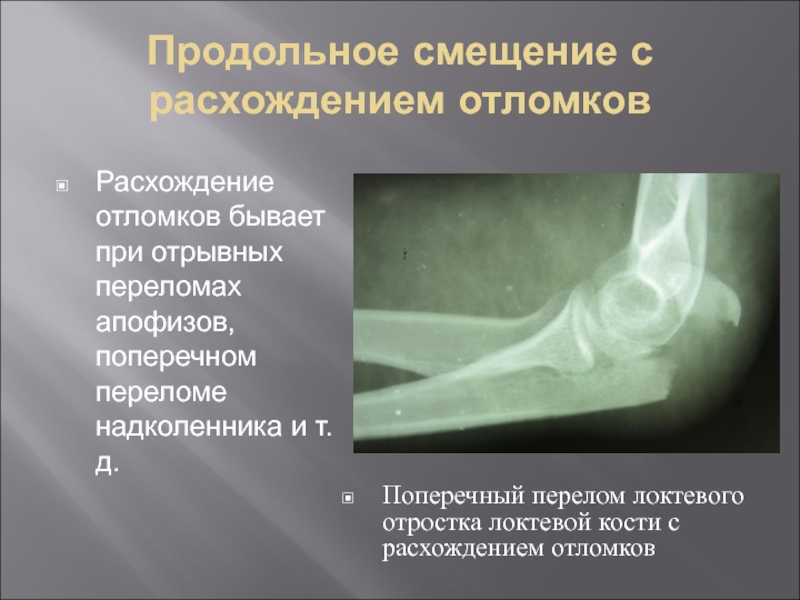 Перелом локтевого отростка