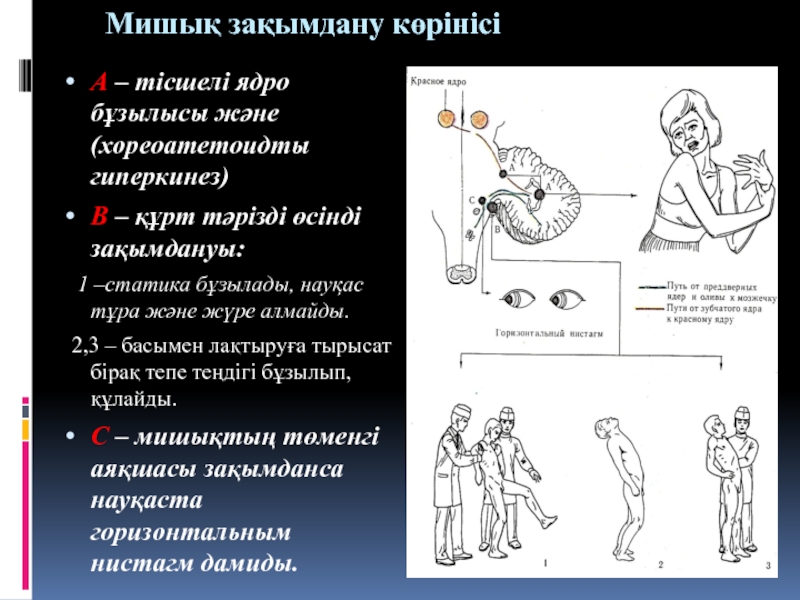 Гиперкинезы возникают при поражении