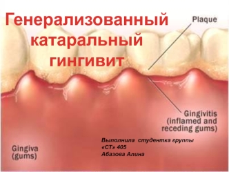 Генерализованный катаральный гингивит