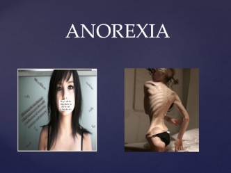 Anorexia