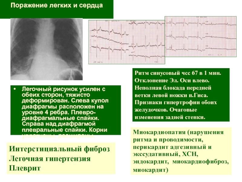 Фиброзная деформация легочного рисунка что это такое