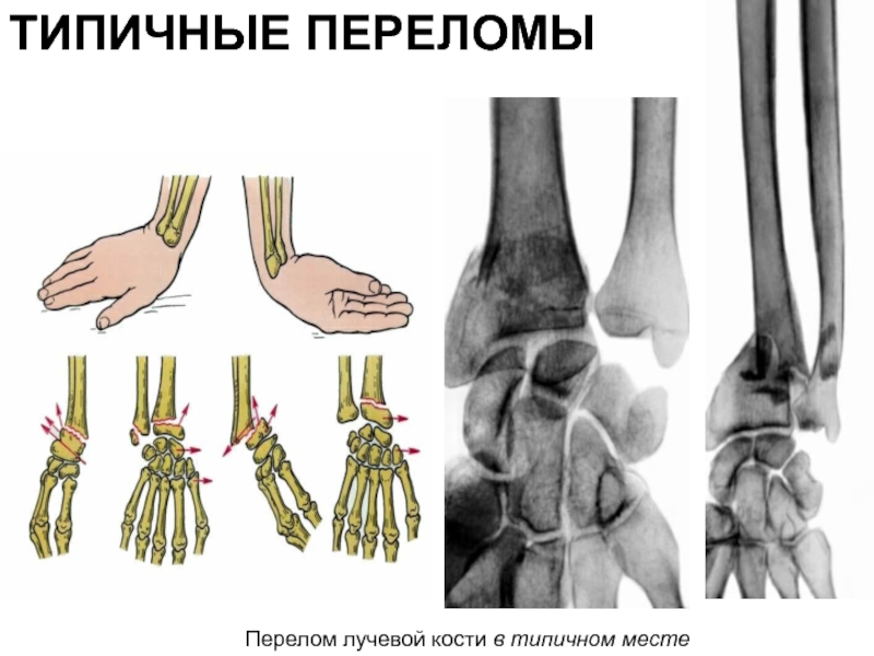 Перелом лучевой кости в типичном месте фото
