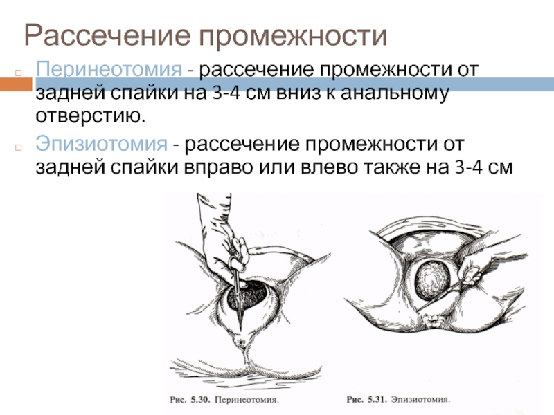 Перинеотомия и эпизиотомия презентация