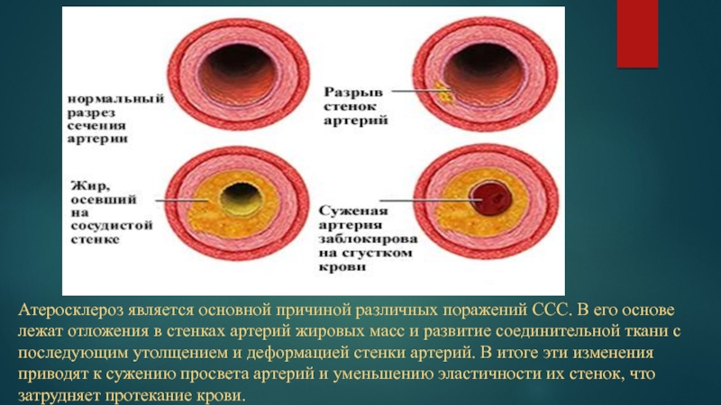 Просвет артерий толщина стенки артерий