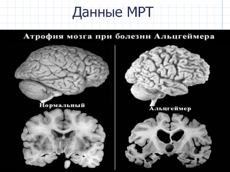 Ковид и мозг. Болезнь Альцгеймера. Томография головного мозга при болезни Альцгеймера.