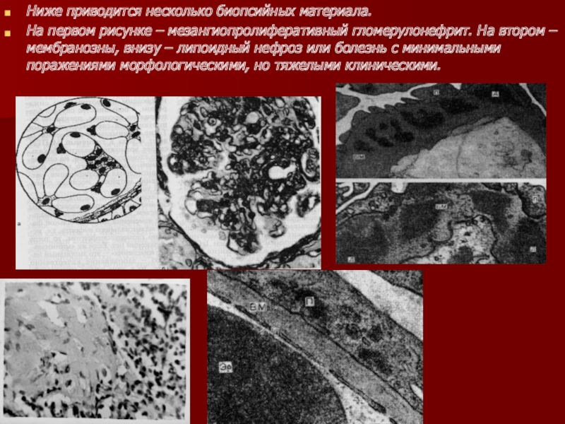 Ниже приведены некоторые. Мезангиопролиферативный нефрит. Липоидный гломерулонефрит. Мезангиопролиферативный гломерулонефрит морфология. Полулуния мезангиопролиферативный гломерулонефрит.