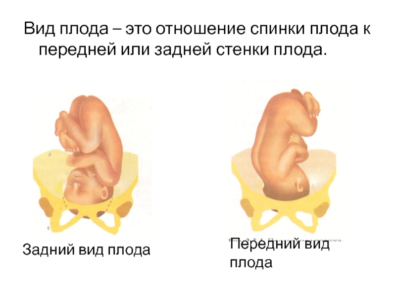 Тазовое предлежание презентация