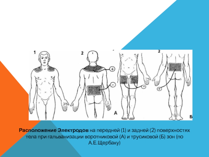 Схема наложения электродов при электрофорезе