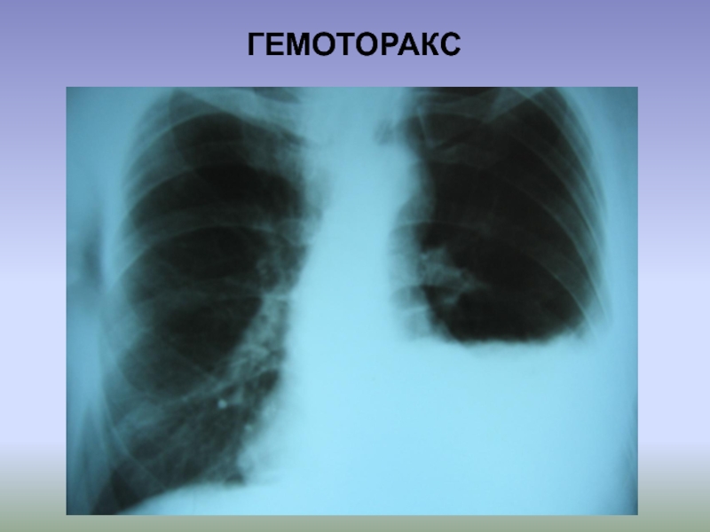 Гемоторакс клиническая картина