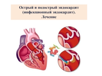 Острый и подострый эндокардит (инфекционный эндокардит). Лечение