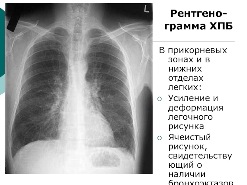 Усилен легочный рисунок в прикорневых зонах что это