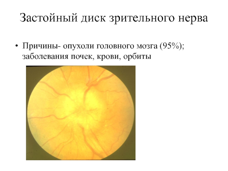 Заболевания сетчатки и зрительного нерва презентация