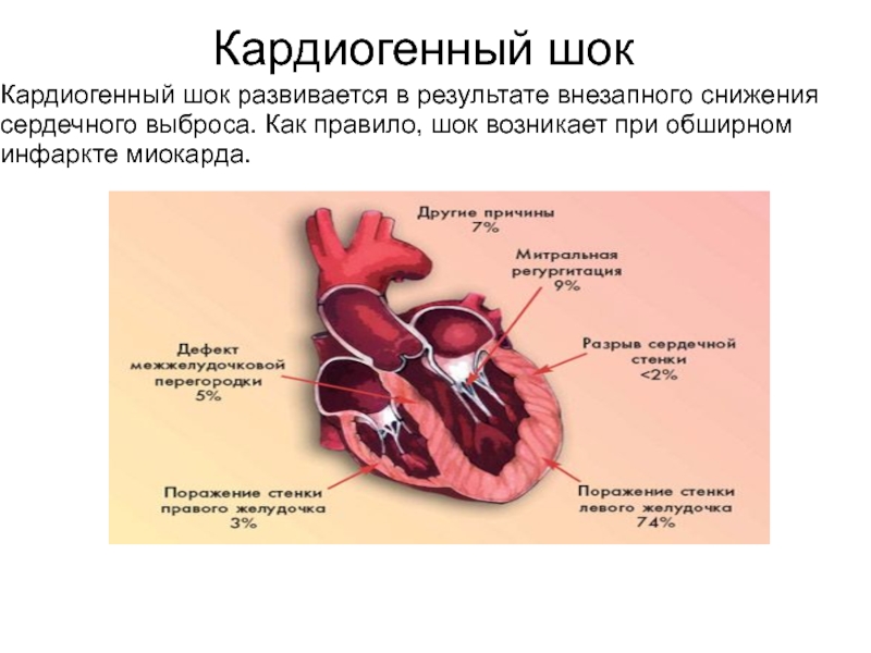 Кардиогенный шок наиболее часто. Кардиогенный ШОК. Инфаркт миокарда кардиогенный ШОК. Кардиогенный ШОК при инфаркте миокарда. Причины смерти при кардиогенном шоке.