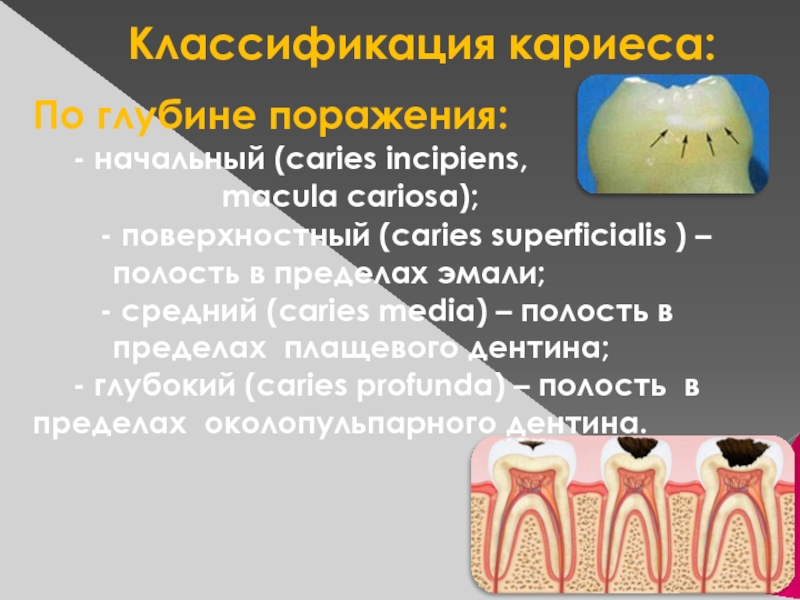 Классификация кариеса презентация